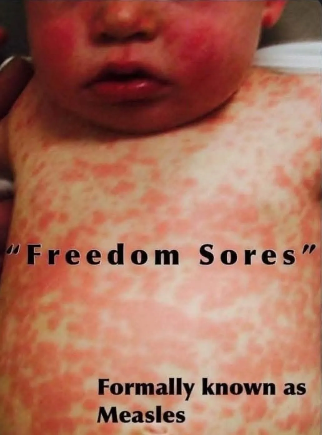 A close-up photo shows a baby's torso and face covered in red, blotchy rashes characteristic of measles. Overlaid text reads…
