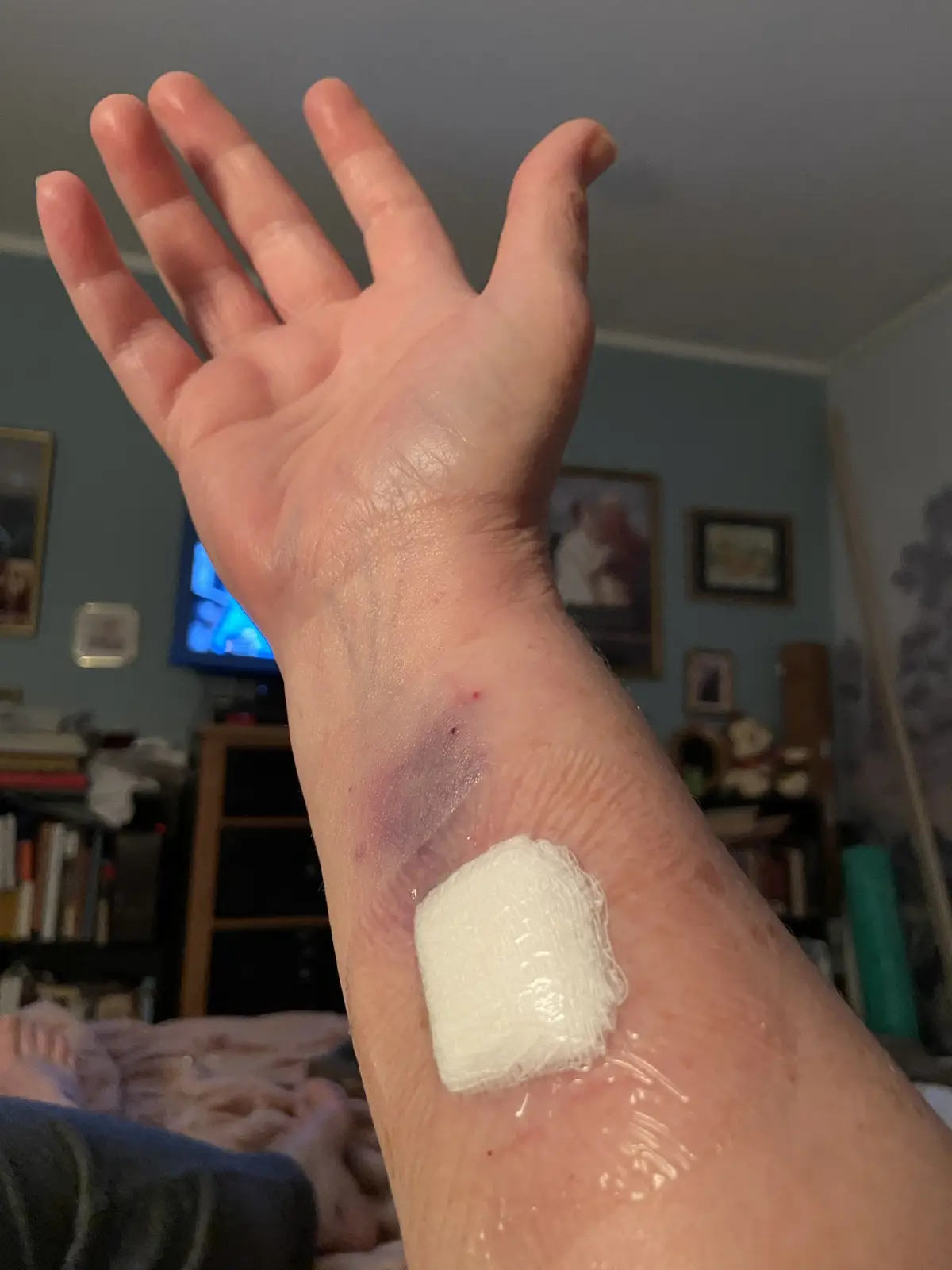 A close-up photo shows a person's left hand and wrist with a visible bruise on the inner wrist and a white gauze bandage…