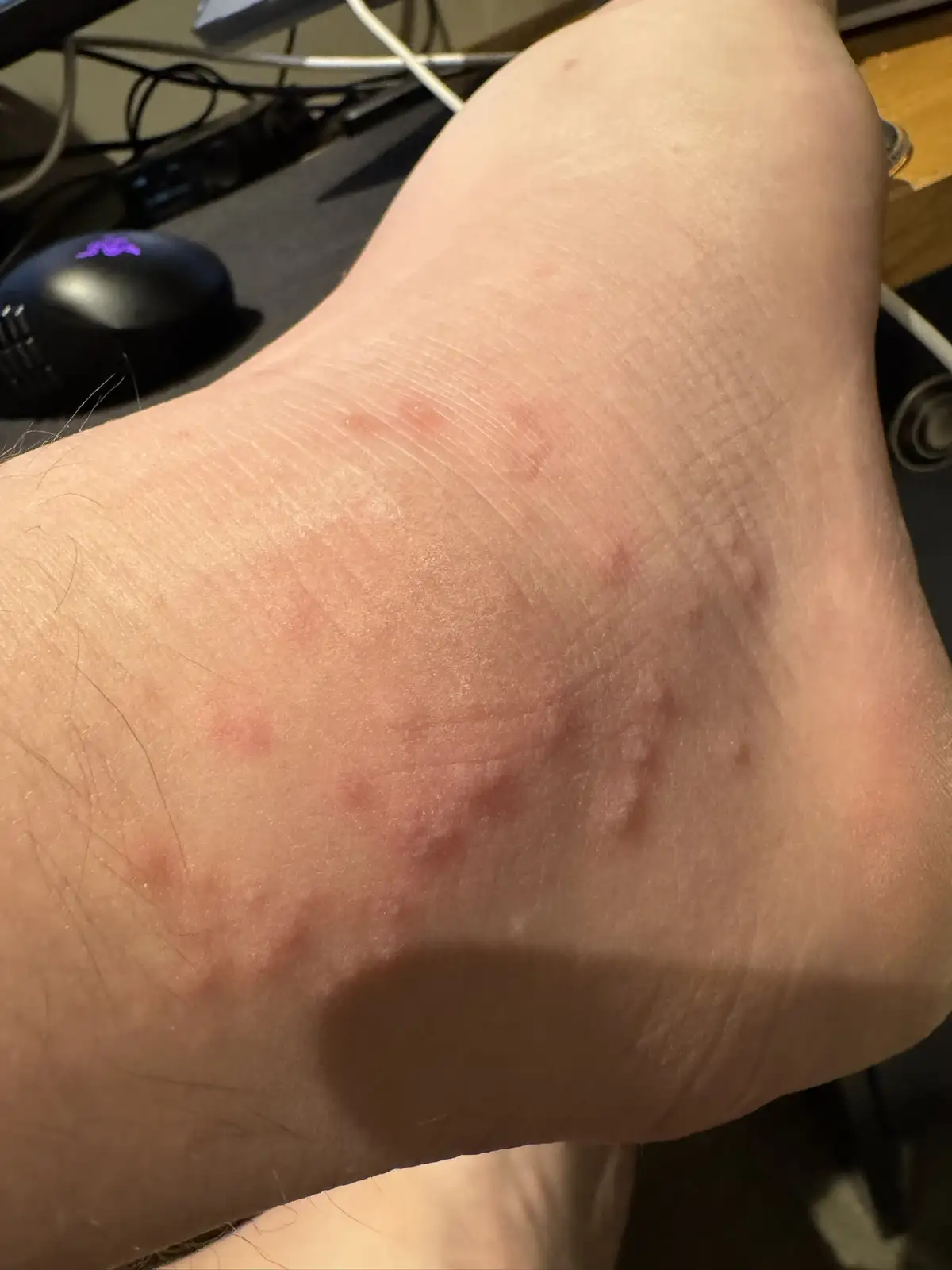 A close-up photo shows a person's forearm with multiple red, irritated bite marks and scratches. In the background, a…