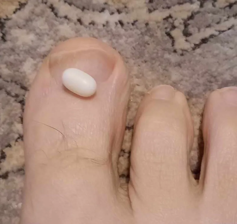 A close-up photo shows a white, oval pill resting on the top of a person's big toe, with the surrounding toes and a speckled…