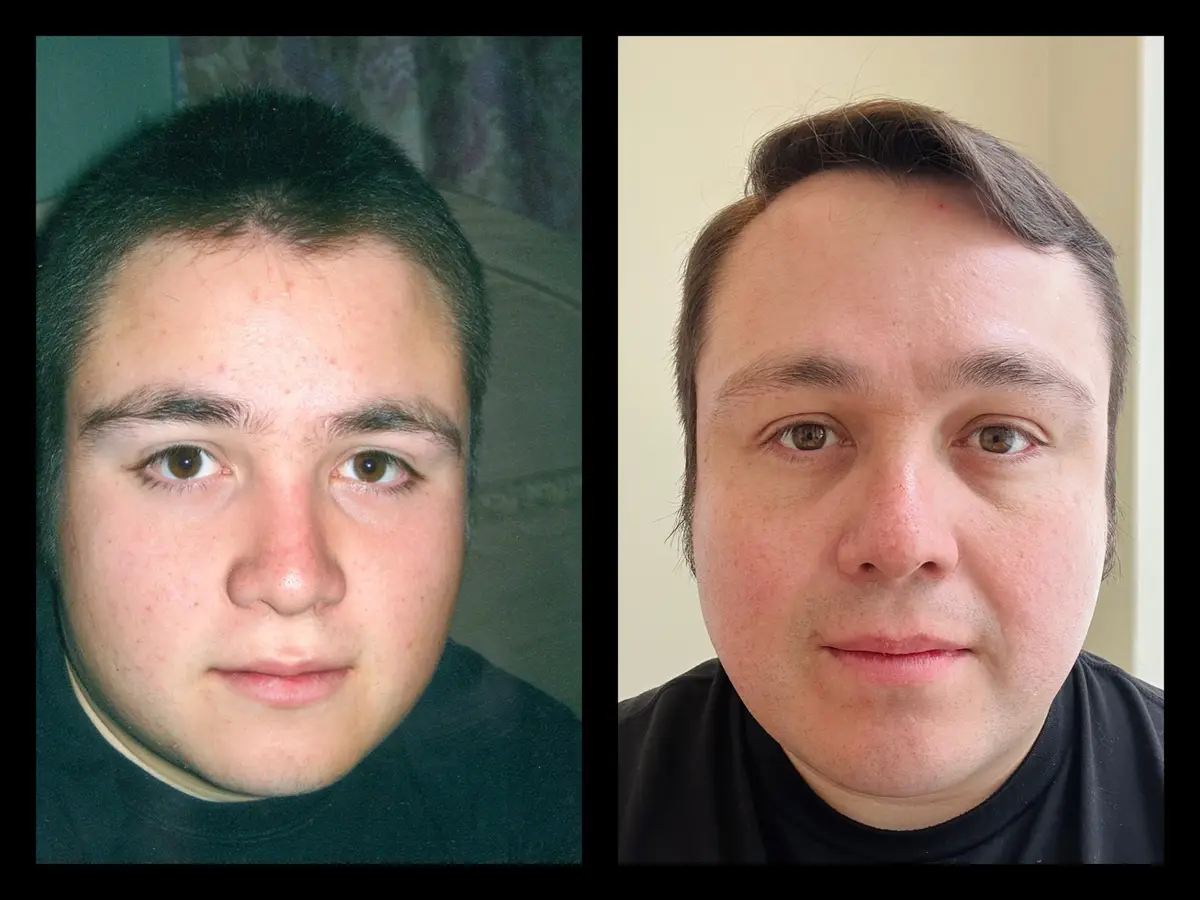 Two side-by-side photos of the same man, left showing him as a younger person with a rounder face and darker hair, right…