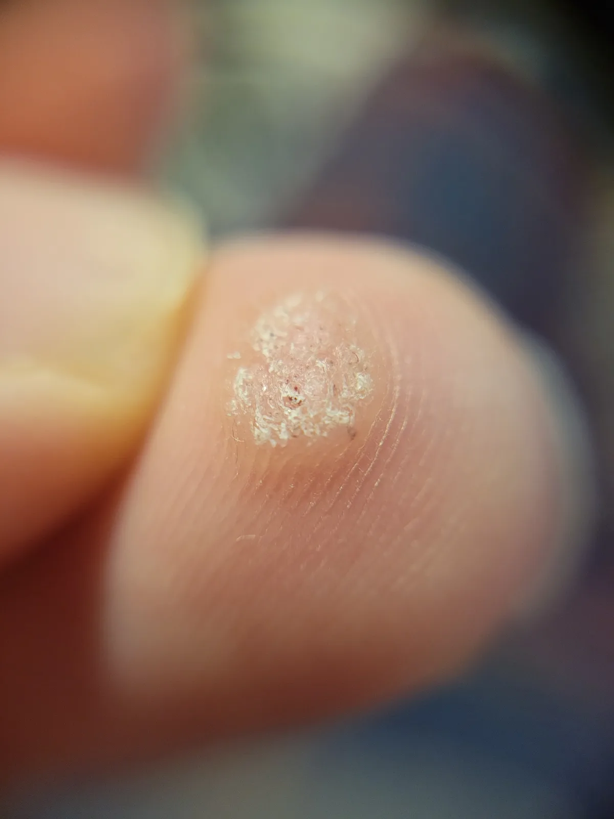 A close-up photo shows a small, rough, scaly patch of skin on the tip of a finger, with surrounding skin and blurred…