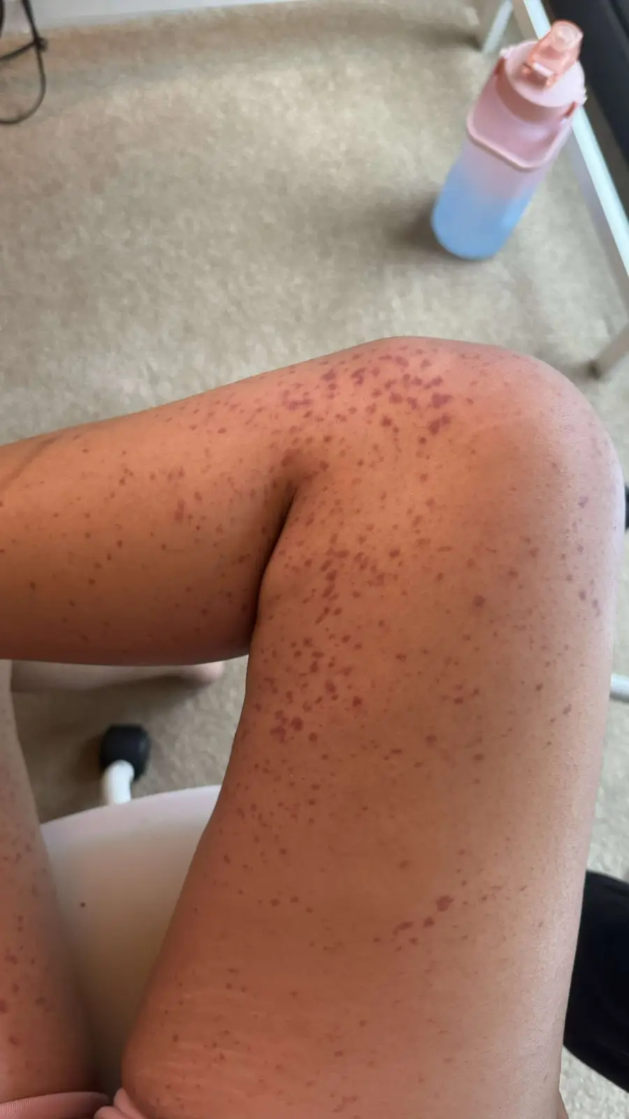 A close-up photo shows a person's leg covered in numerous red, itchy-looking mosquito bites, with a pink and blue water…