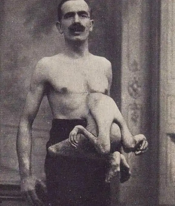 A black-and-white vintage photograph shows a shirtless man with a mustache holding a small, nude child in a contorted…