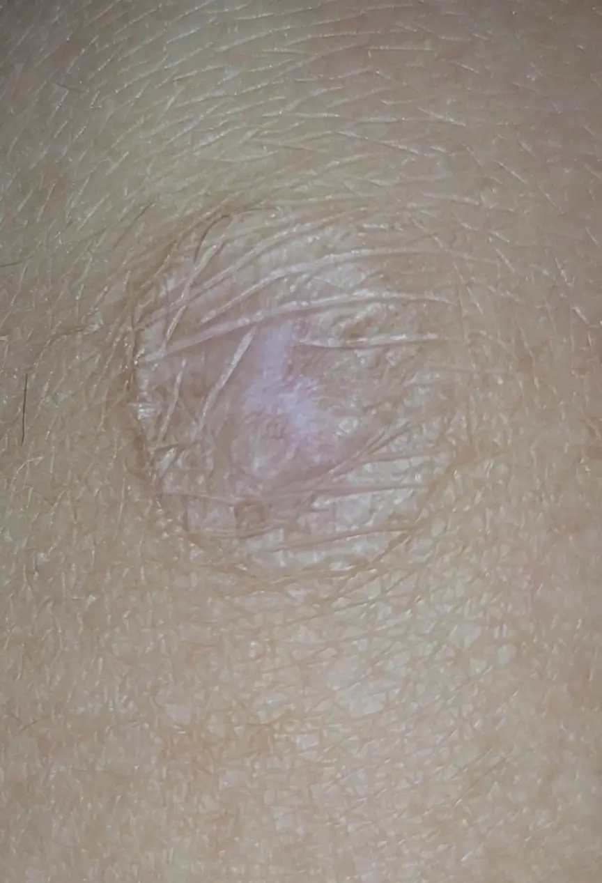 A close-up photo shows a small, slightly raised, pale pinkish skin lesion on human skin, surrounded by fine hair and visible…