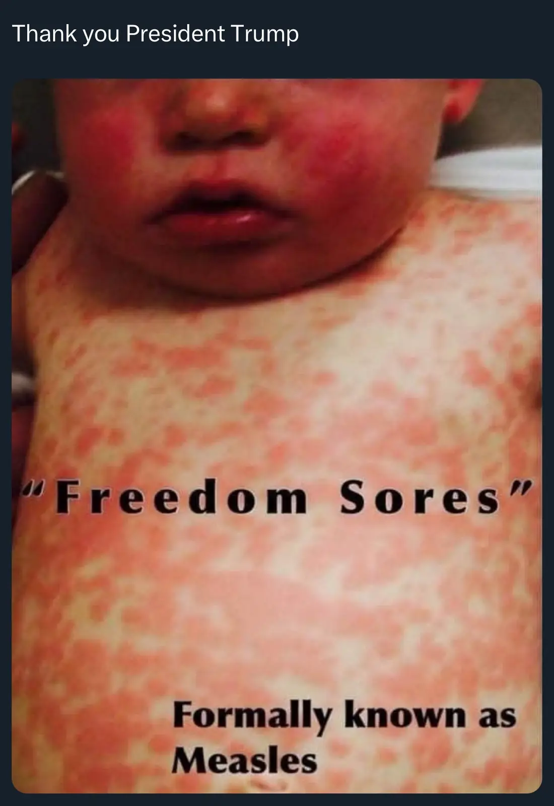 A close-up photo of a baby with visible red, blotchy measles rash covering its face and chest. Overlaid text reads 'Thank…